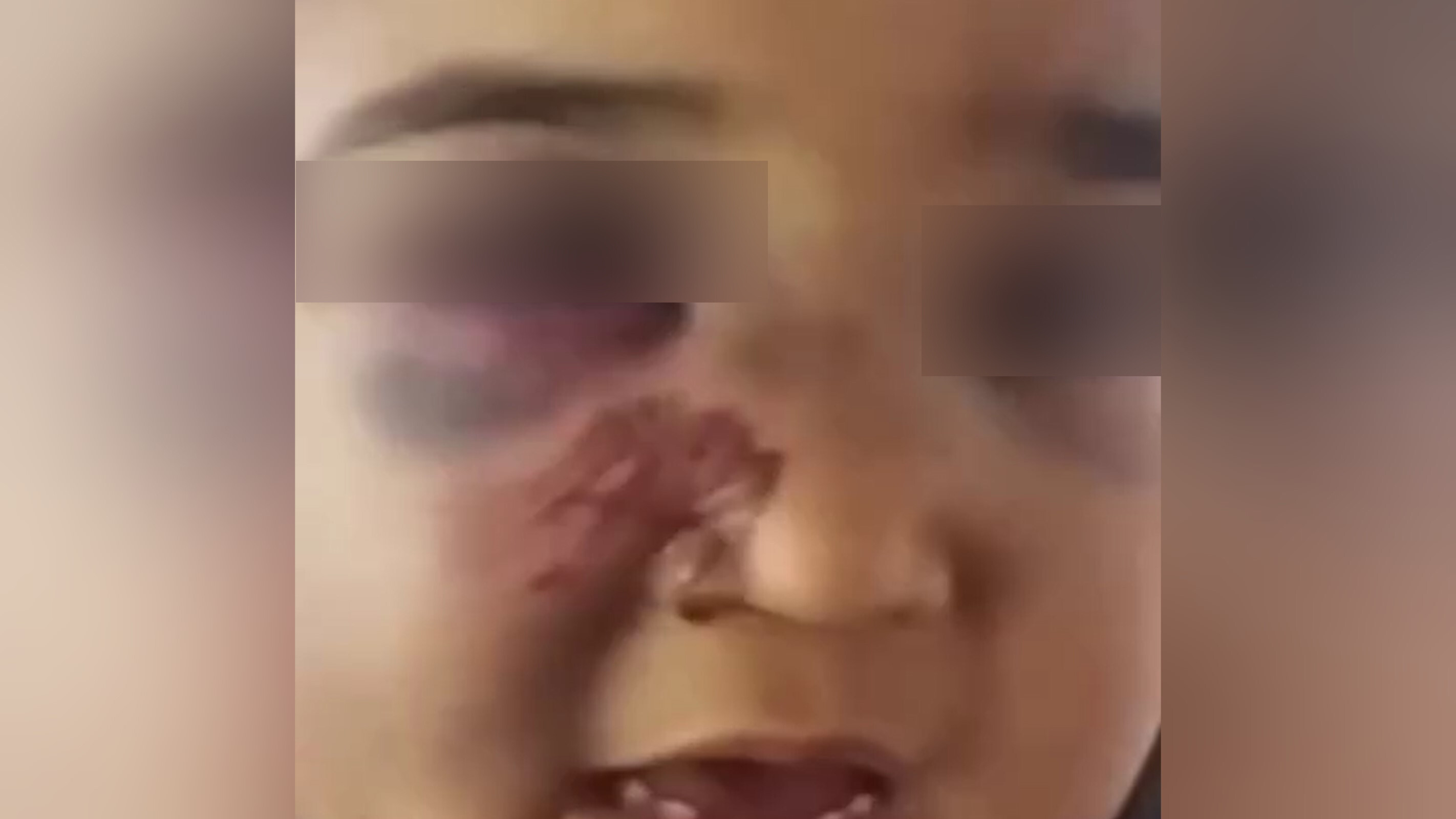 Стало известно, при каких обстоятельствах ребенок из Самарканда получил синяк и ссадины на лице
