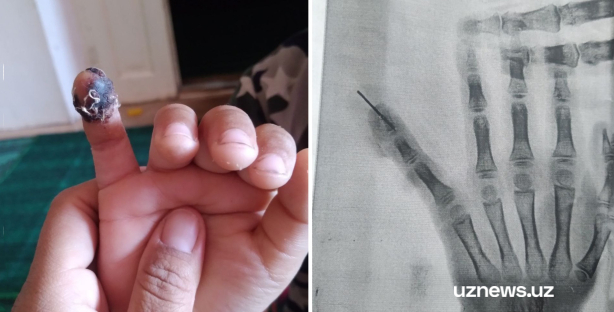 В Хорезме пятилетнему ребенку вонзили иглу в палец — видео
